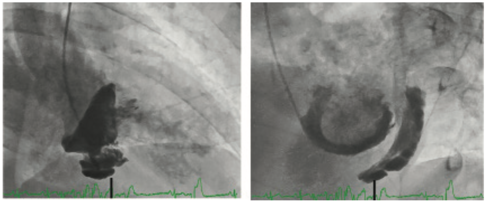 Hemodynamics That Can Make For a Lifesaving Decision in the Cath Lab